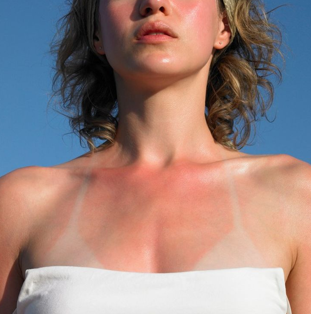 The above image shows what tan lines can look like